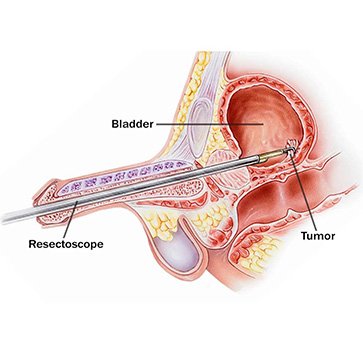 Bladder Tumor Surgery